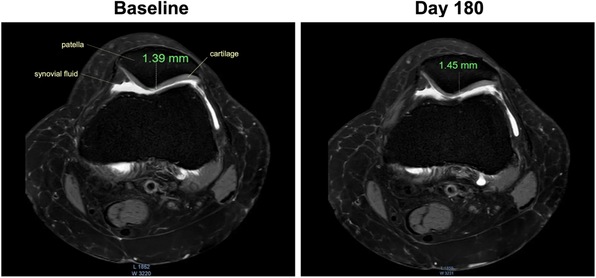 MRI comparing baseline to 180 days out